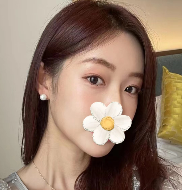 美女模特,双眼皮做毁变多层,赴京修复,自然到拍案叫绝!