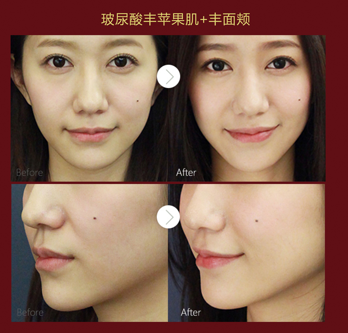 玻尿酸的副作用和危害大揭晓,是否会引起过敏的反应呢?