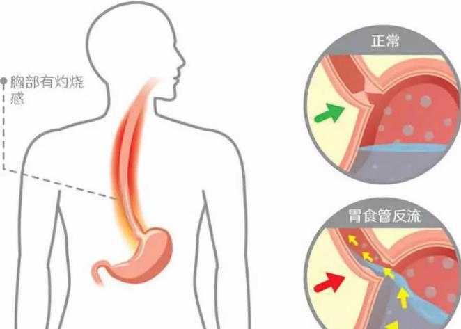 飯後燒心難忍,噁心反胃,胃食管反流怎麼辦!