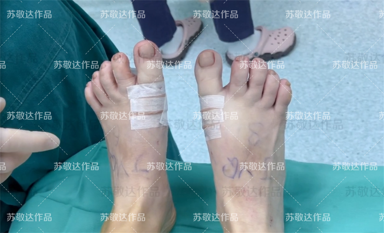 35岁女士大脚骨术后半年恢复记录,纯干货分享,功课必备!