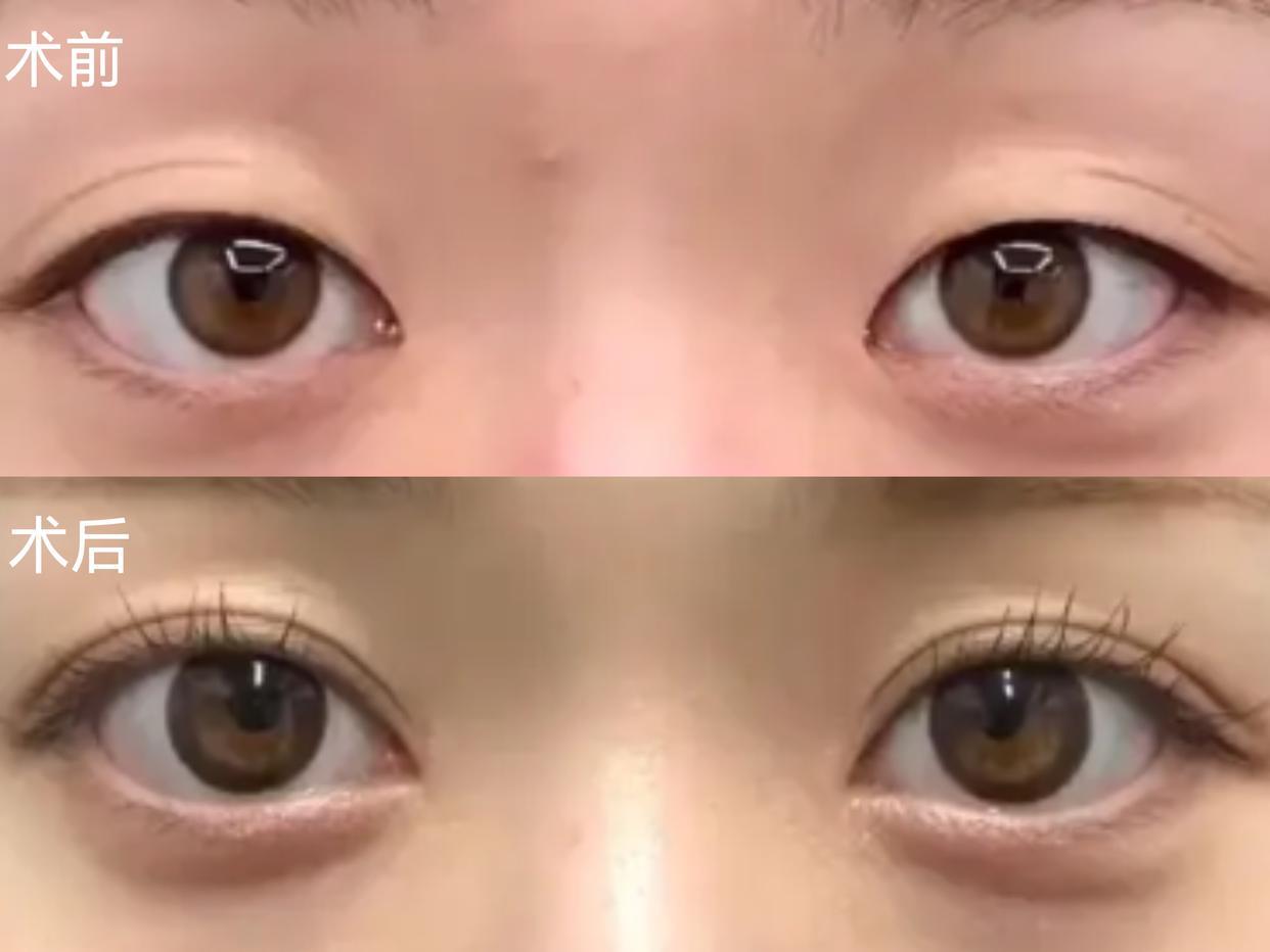 秦海璐做双眼皮的思路都是美商干货!