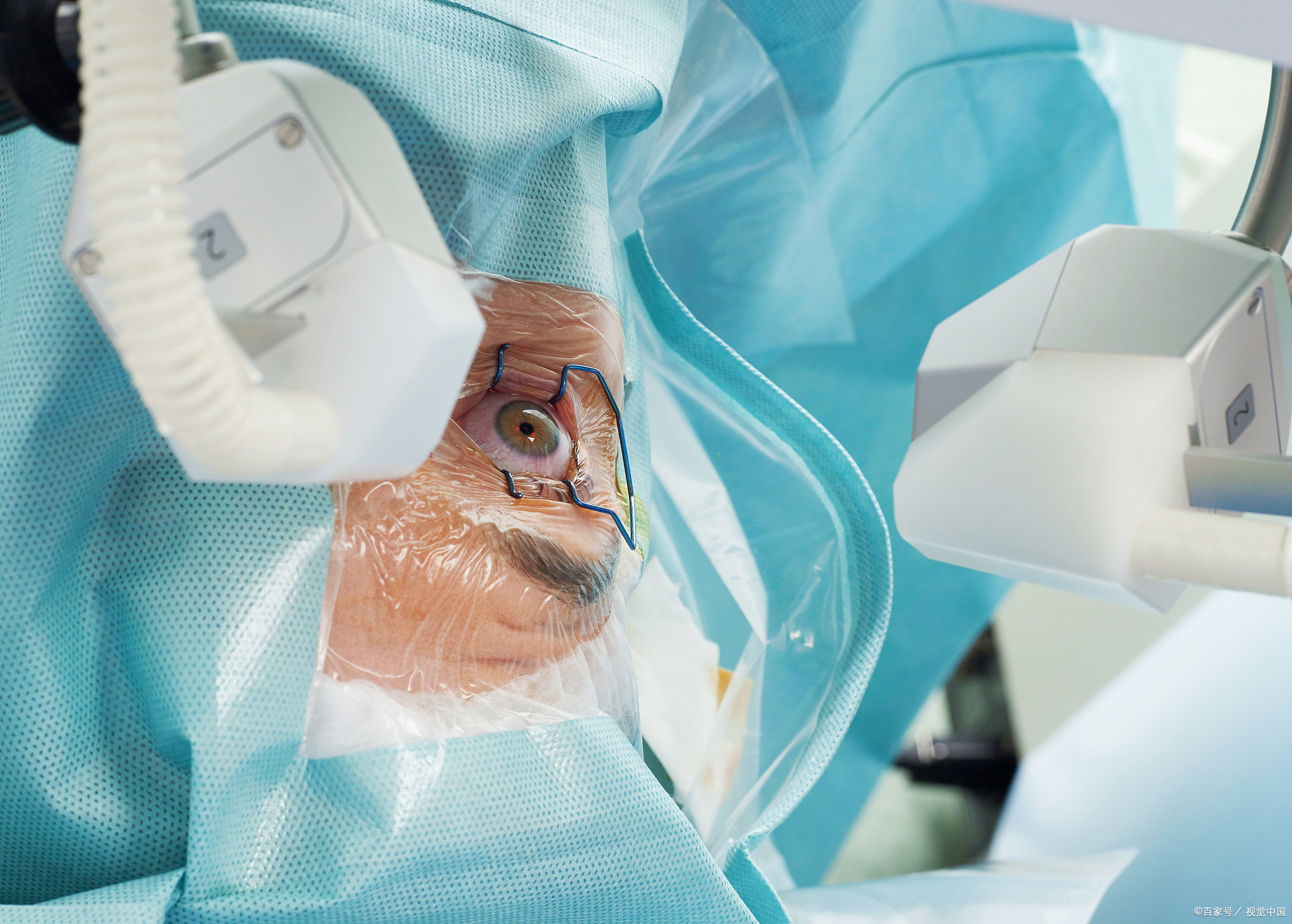 半飞秒手术:精确激光技术实现近视矫正的突破