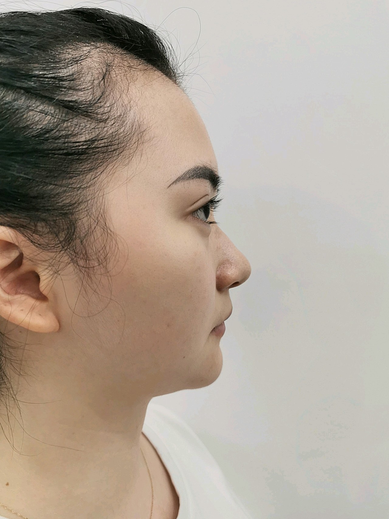 想要鼻子好看,千万别忽略山根,隆鼻前你需要注意什么?