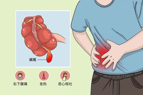 盲肠疼痛位置图图片
