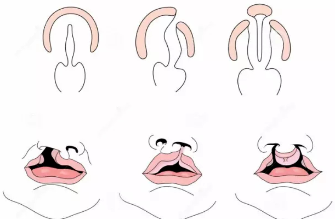 腭裂兰氏手术示意图图片
