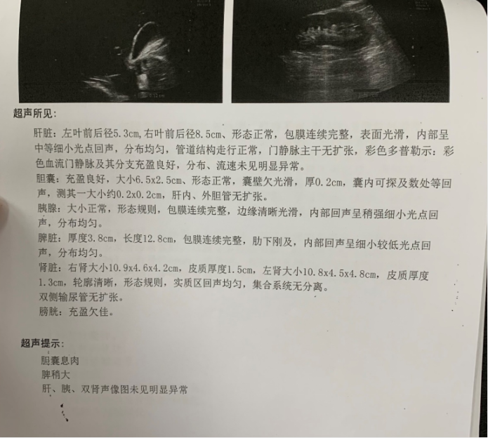 从一个病例认识「真性红细胞增多症」