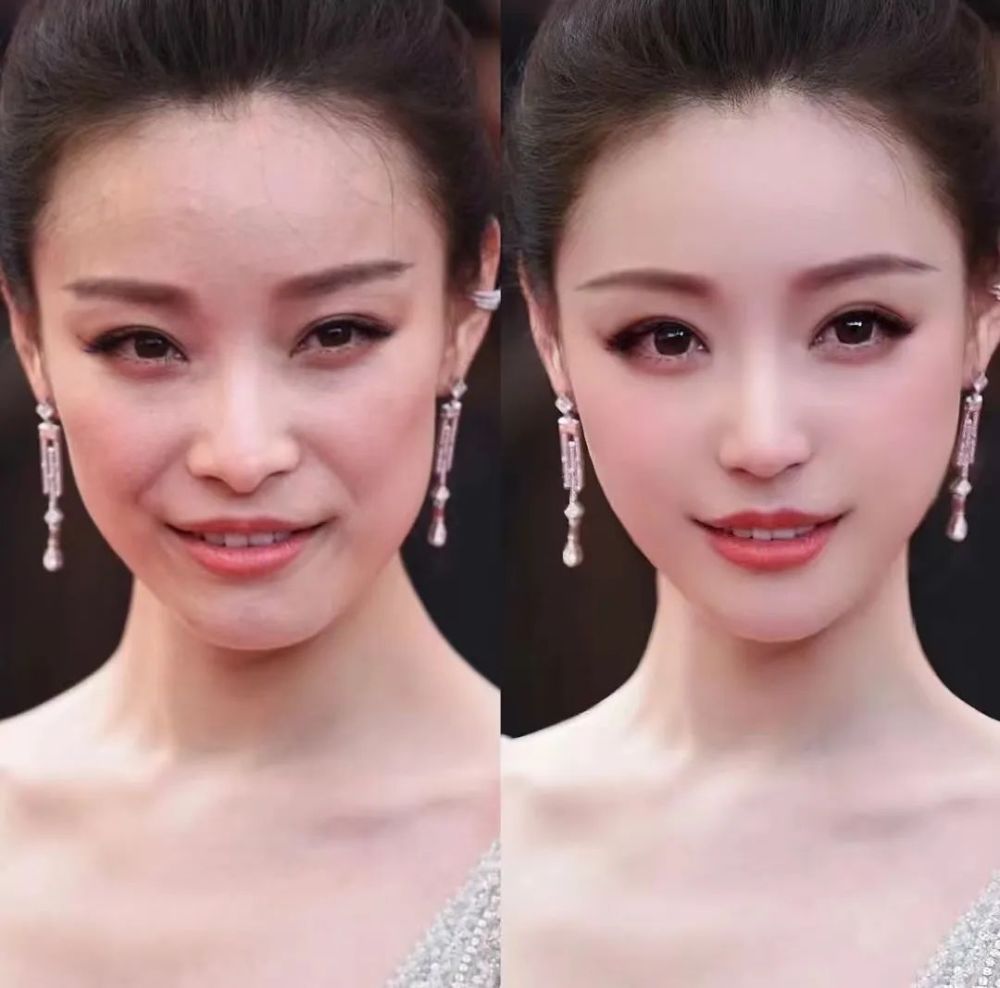 去除法令纹,方能放肆的笑,是该采取面部提升还是填充凹陷?