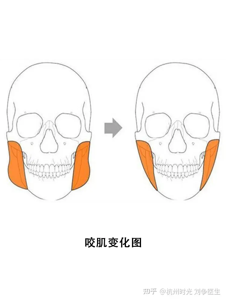 造成咬肌肥大的原因有哪些呢?