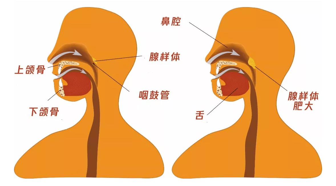 腺样体肥大位置图片