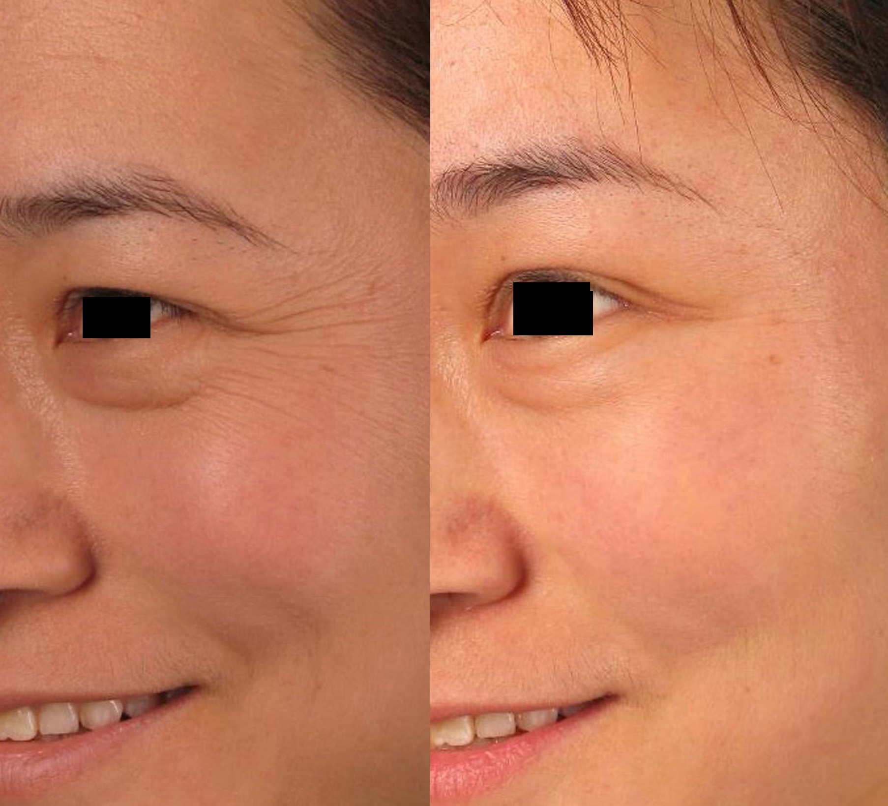 一女子做川字纹整容,术后变面瘫,正确消除川字纹的方法是什么?