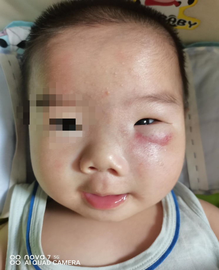 5月男童眶周卡梅综合征介入微创治疗病例