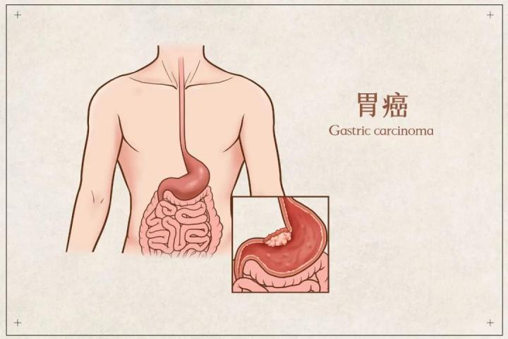 研究发现:这5种常见的危险因素是胃癌的诱因