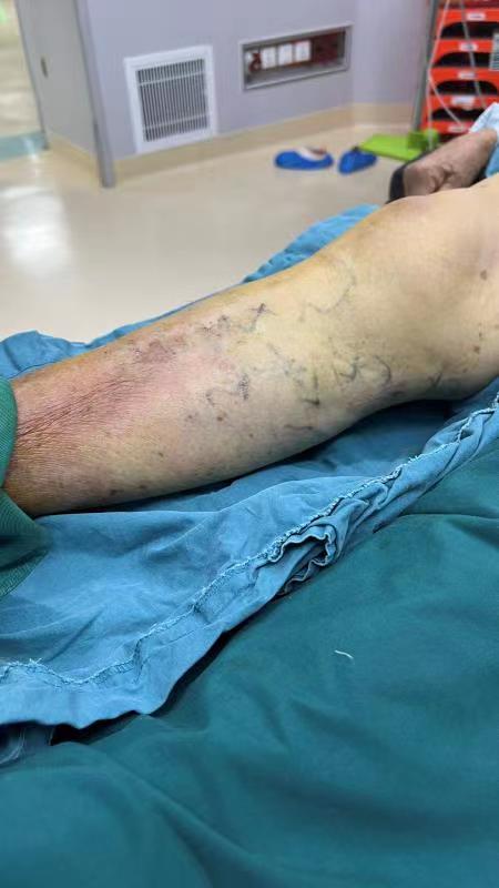 「静脉溃疡案例29」七旬老人走路一瘸一拐,又双叒叕是"老烂腿"