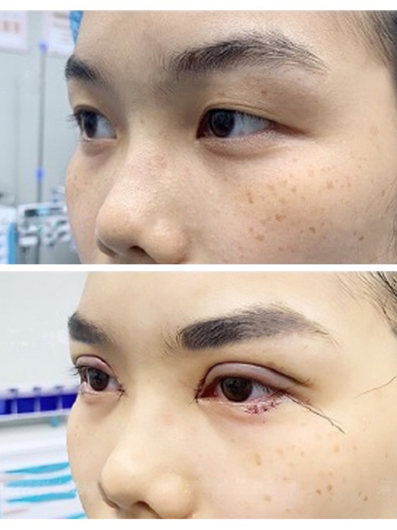 花1.5万做眼部整形手术,术后视力模糊生活被毁,值得吗?