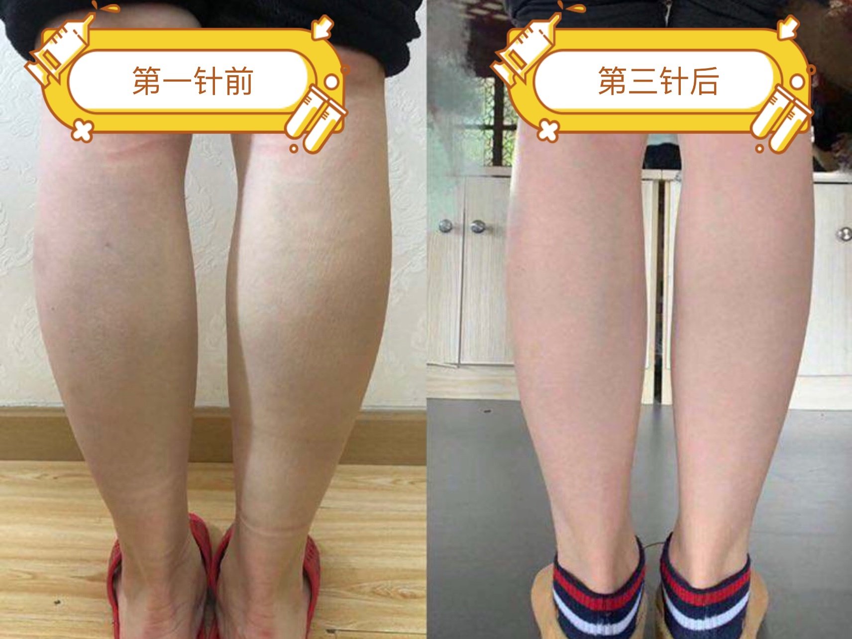 秀腿的季节到了,哪些人适合注射瘦腿针?打一次维持多久