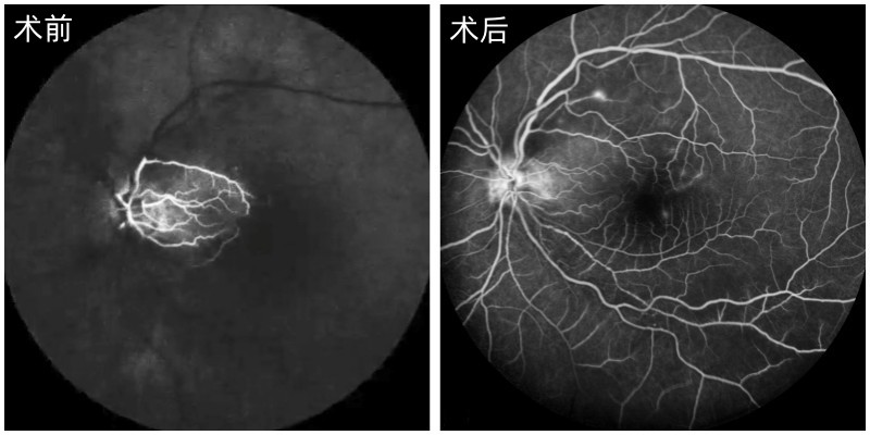 老人突发视网膜动脉阻塞,北京爱尔英智谷威院长紧急施救