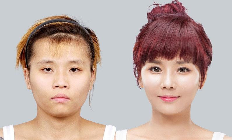 女子贷款做5项面部整容,术后嘴巴歪斜,要求全额退款并赔偿损失