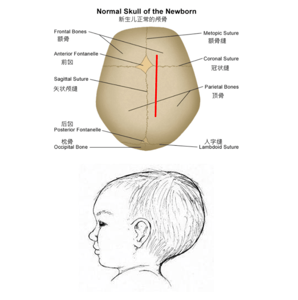 矢状缝闭合图片