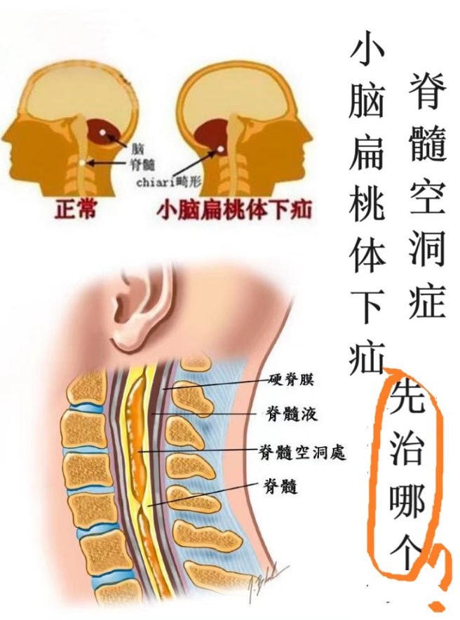 小脑扁桃体解剖图图片