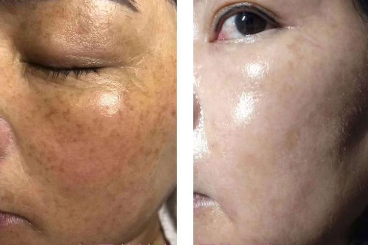 光子嫩肤祛斑效果好不好?几次能彻底?需要花费多少钱?