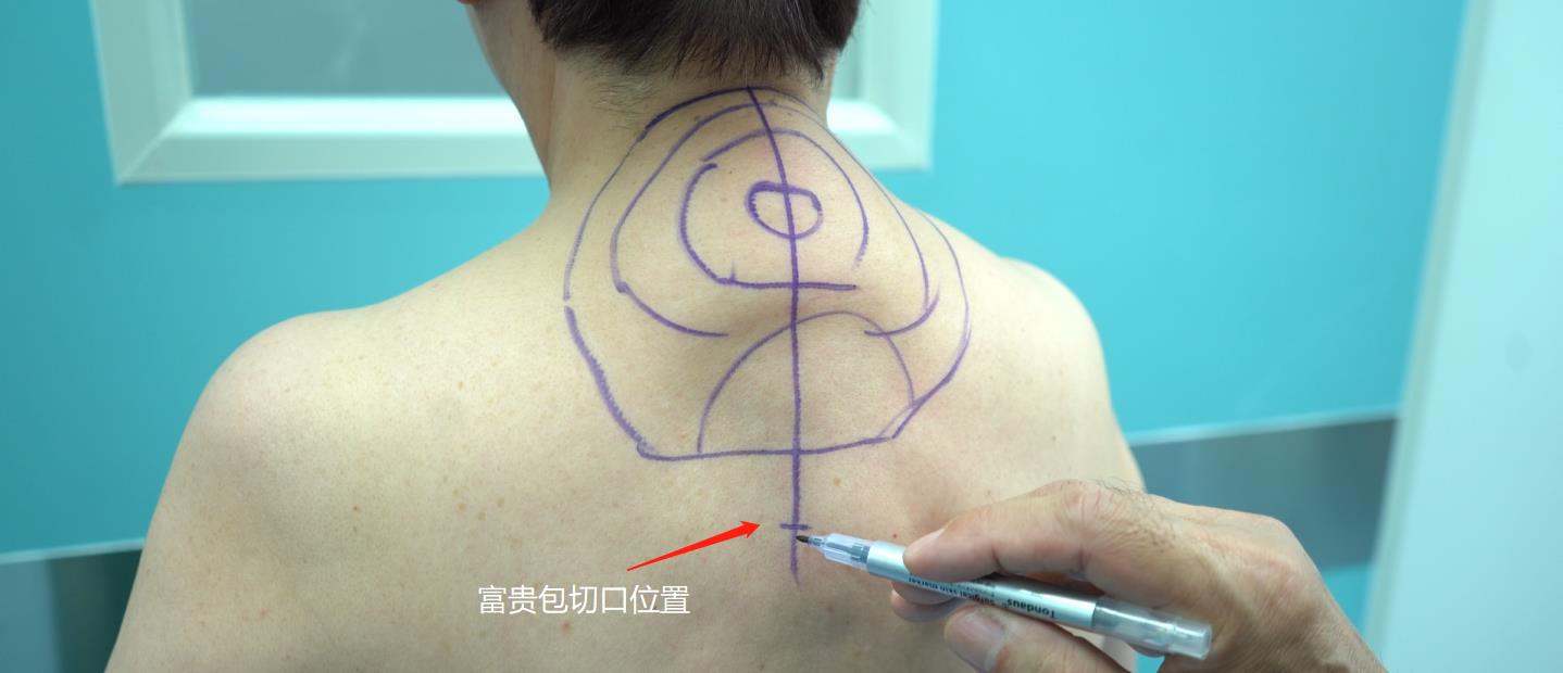 70岁来北京做富贵包微创乳化吸脂手术,医生公开手术真实细节