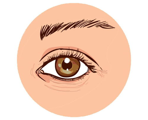 从眼周细纹到泪沟,眼袋,眼周衰老问题如何改善?