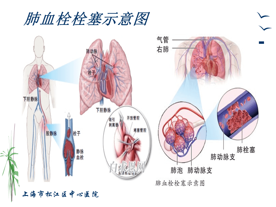 肺栓塞的4大症状要警惕
