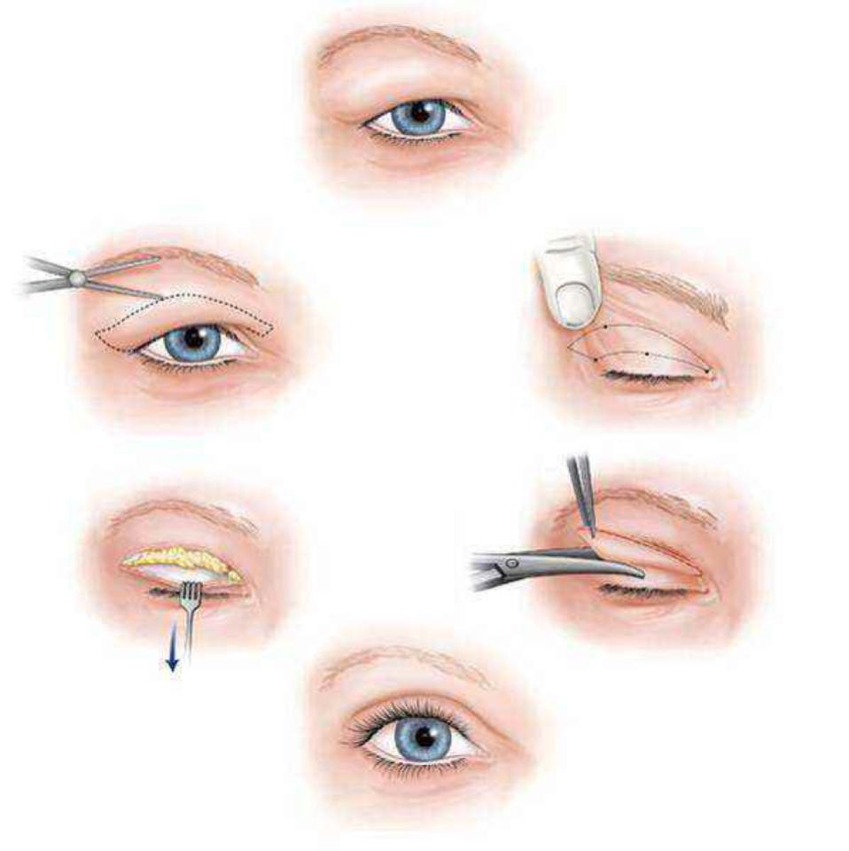 什么样的双眼皮手术方式适合你?费用需要多少?本文带你了解一下