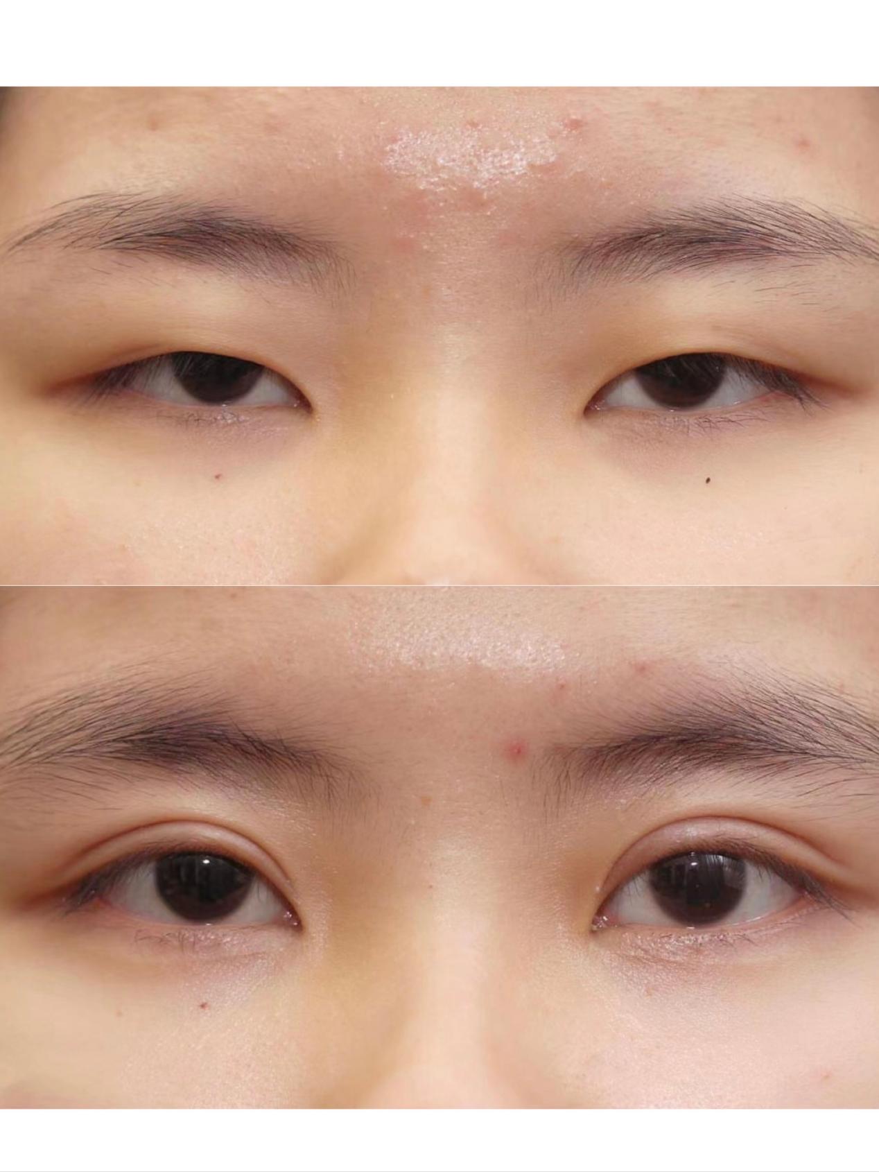 单眼皮上睑下垂严重,眼睛像睁不开,割完双眼皮后颜值提升不少