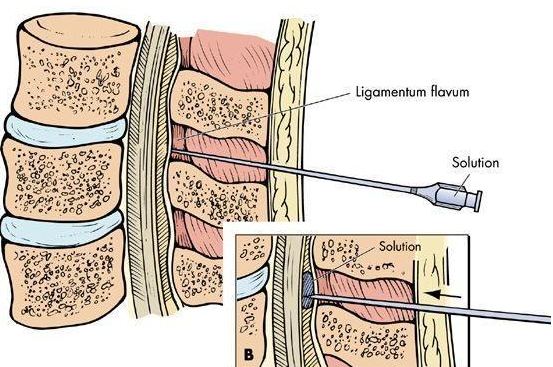 手术选择"硬膜外麻醉"方式好不好?麻醉科医生告诉你