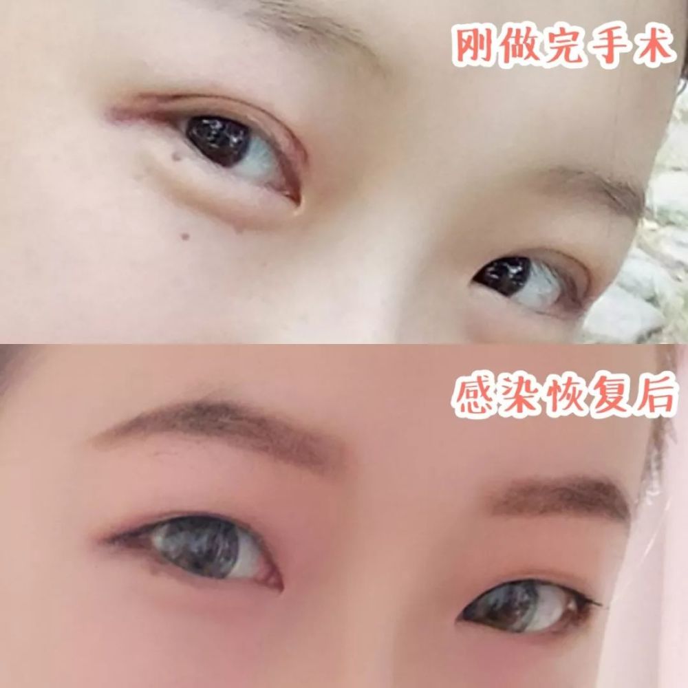 31岁周冬雨,双眼皮松了?双眼皮随皮肤松弛消失不见了怎么办?