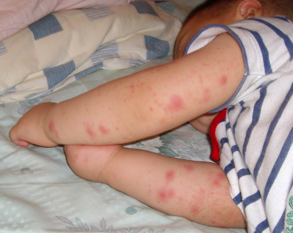 教你"小窍门",螨虫跑光