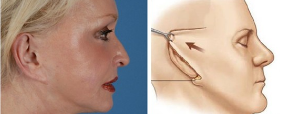 拉皮手术到底是什么,效果如何?终于有人把拉皮手术讲清楚了!