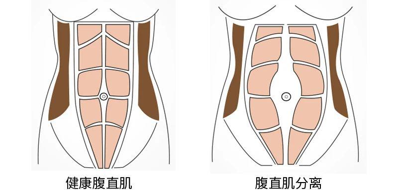产后多久可以做腹壁成形