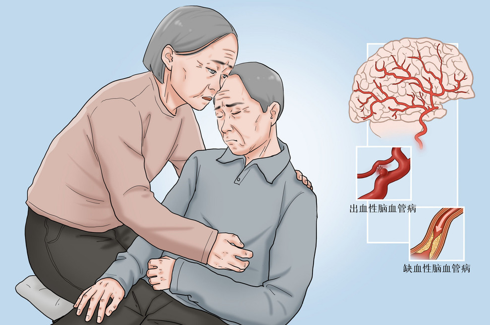 脑卒中是一种急性的脑血管病,脑卒中是怎样发生的年轻人也要警惕