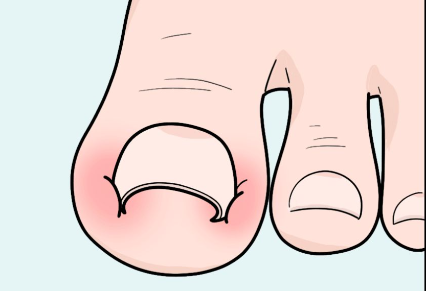 脚趾甲往肉里钻,一碰就疼?医生教你小方法,预防甲沟炎告别疼痛