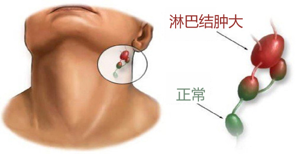 淋巴结肿大不要掉以轻心,有可能是恶性淋巴瘤