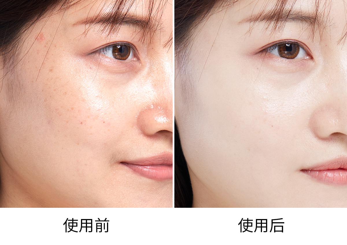 水光针注射后要注意什么