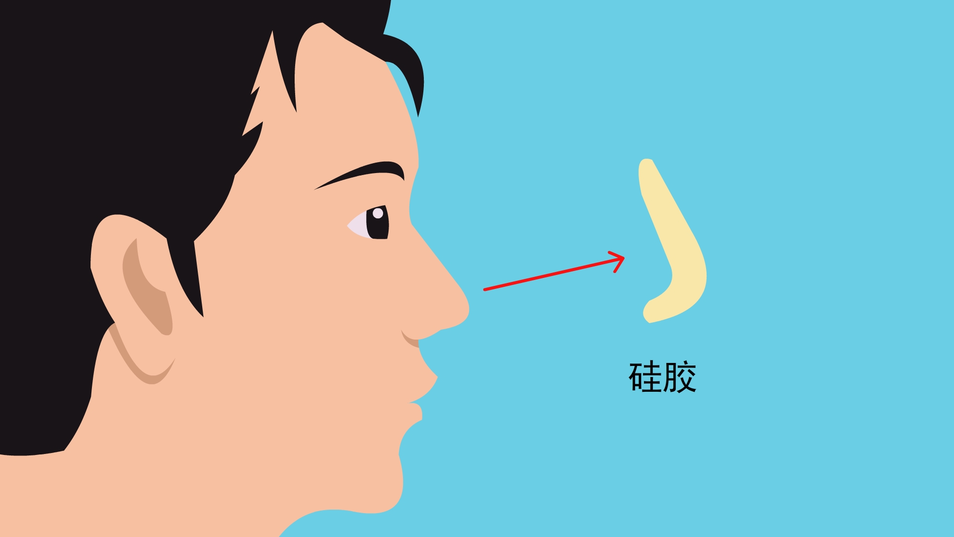 想拥有气质美鼻?朝天鼻,蒜头鼻,宽鼻分别该如何矫正?