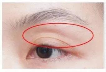 眼睑凹下去了,这是什么原因,哪一种医美改善眼睑凹陷可靠?