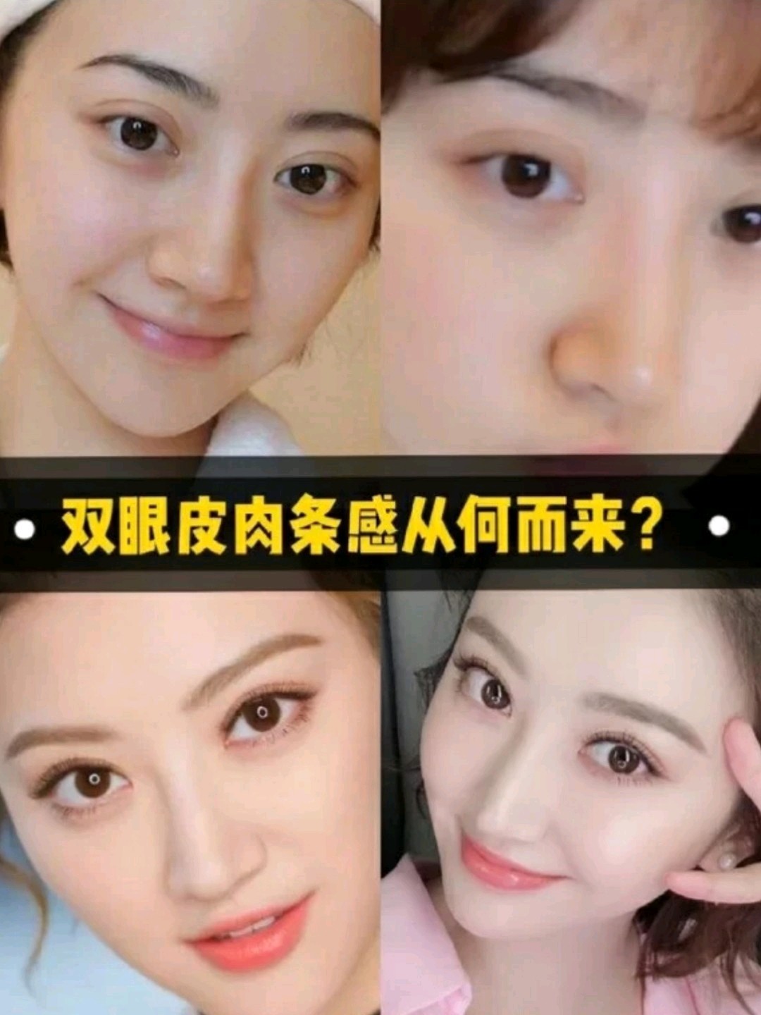 双眼皮术后肉条感重,是怎么回事?要怎么修复比较好呢?