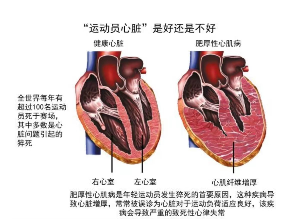 一般人都会羡慕运动员的心脏,实际上运动员心脏没有几个是好的!