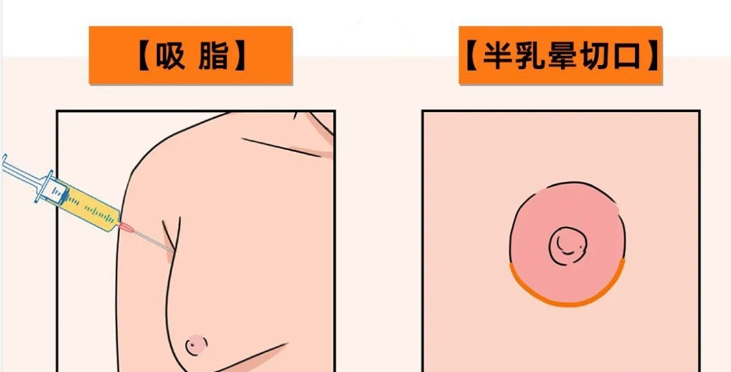 未婚女性 沒生孩子可以做乳房縮小術嗎?