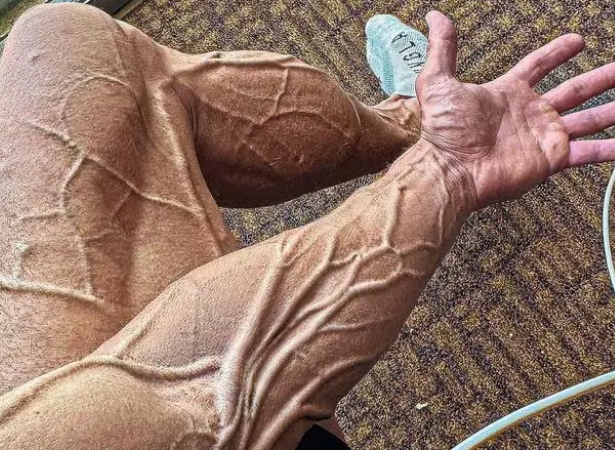 健身等于健康?网红拉丝哥看似肌肉男,身体曾发出危险信号