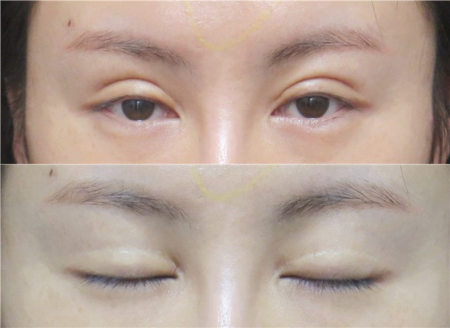 "屠龙刀"割的超宽双眼皮,不但不好看还造成创伤性上睑下垂