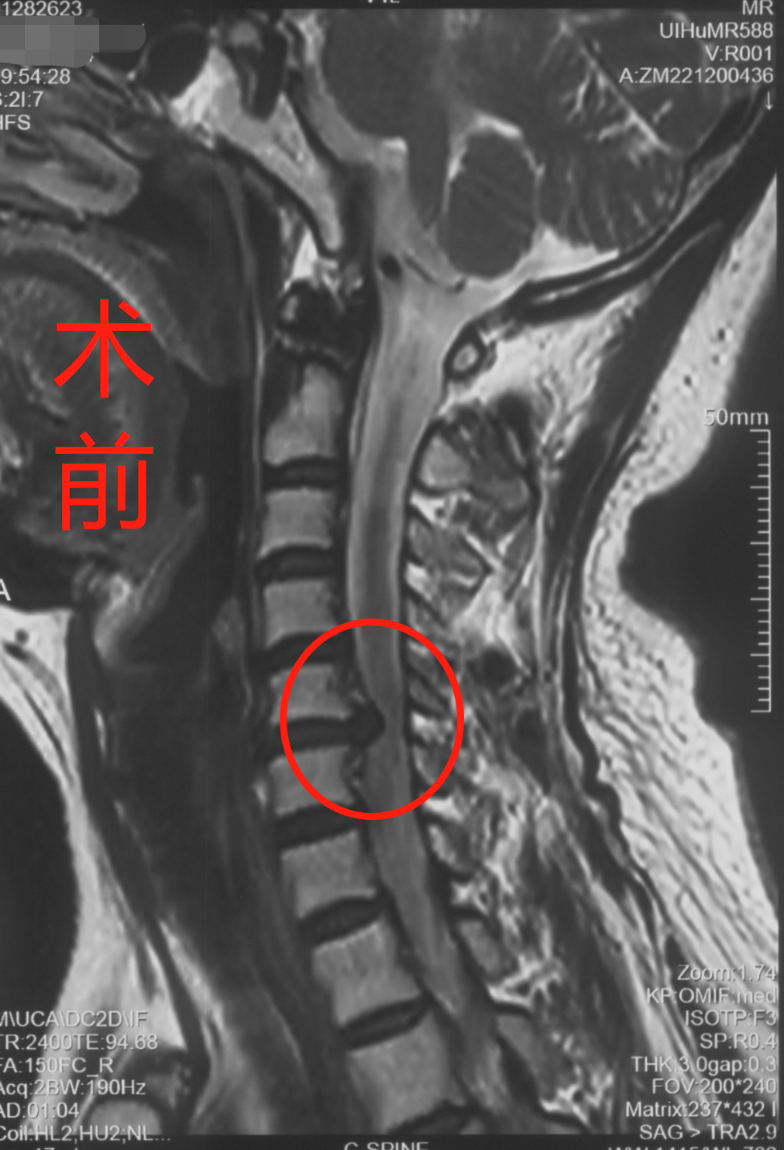 突然"手笨"的手工达人怎么了?了解一下神经根型颈椎病!