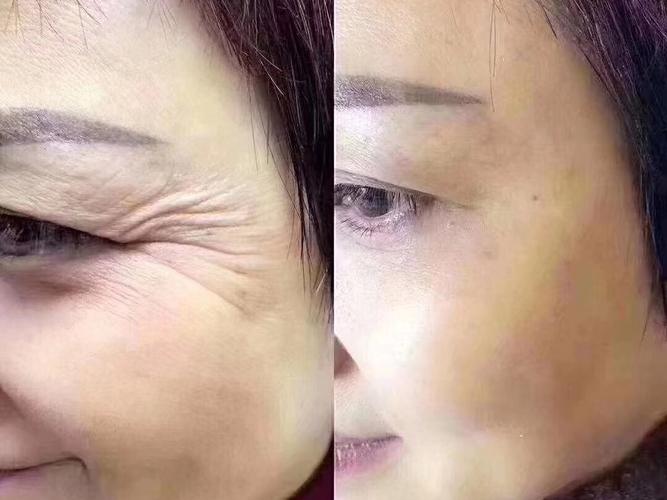 除皱针用于哪些部位有效,如何判断除皱效果,该怎么看呢?