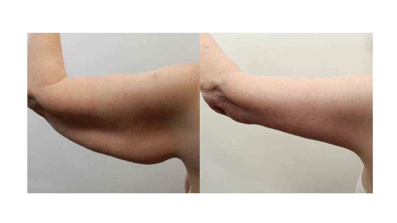 手臂松弛拜拜肉,非手术和手术的多种方法,一起来探讨