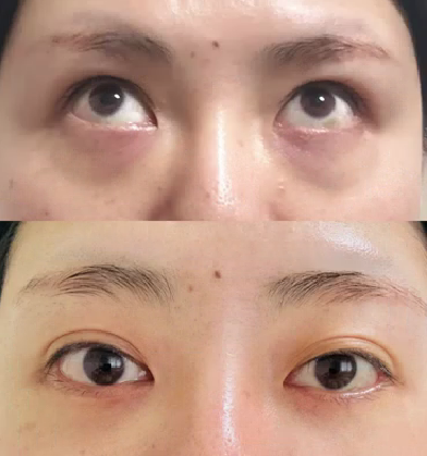 33岁宋轶成功去眼袋,回春变年轻!俘获小4岁男友白敬亭?