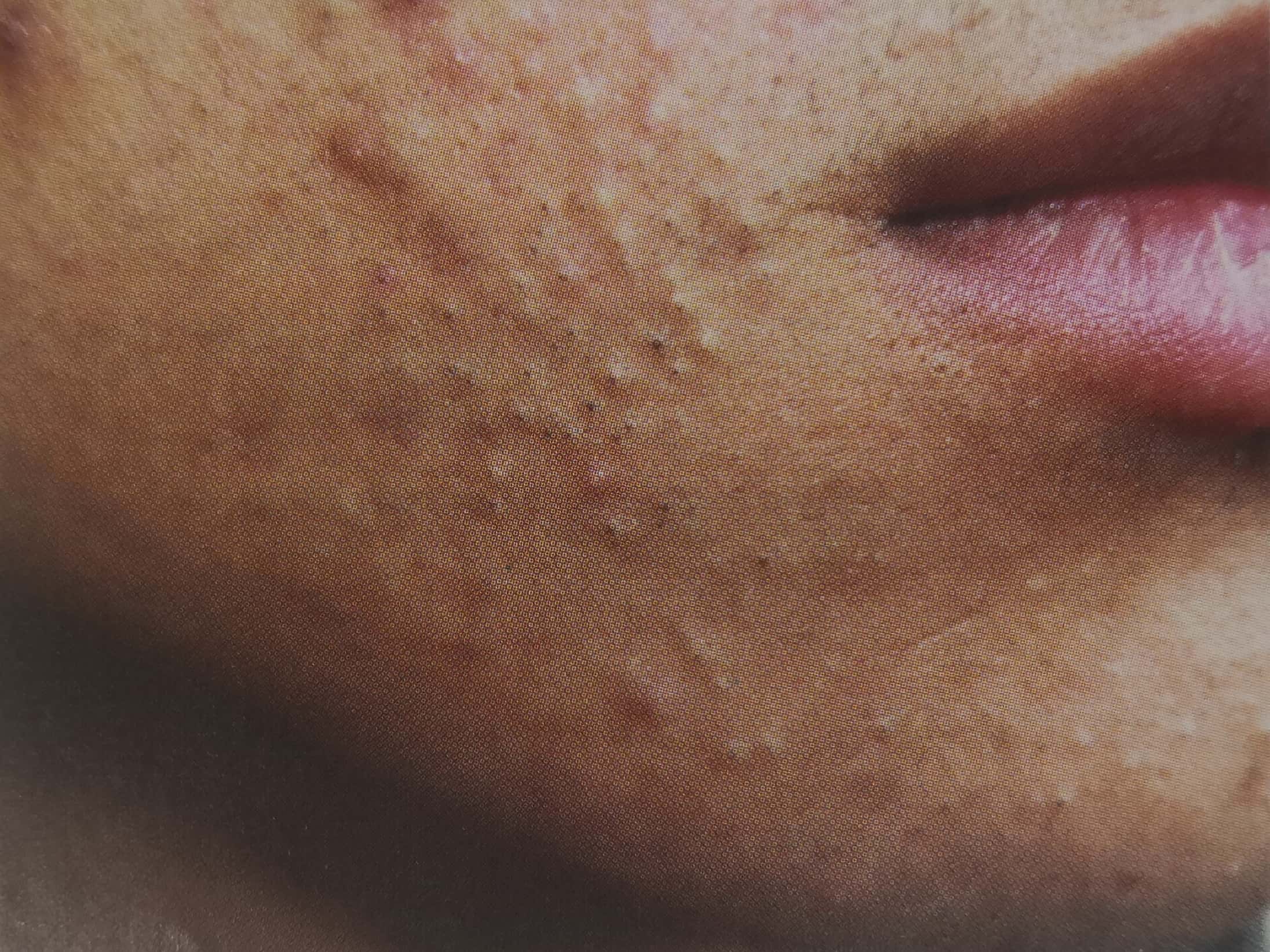 战痘宣颜丨粉刺会给我们的肌肤带来什么样的危害